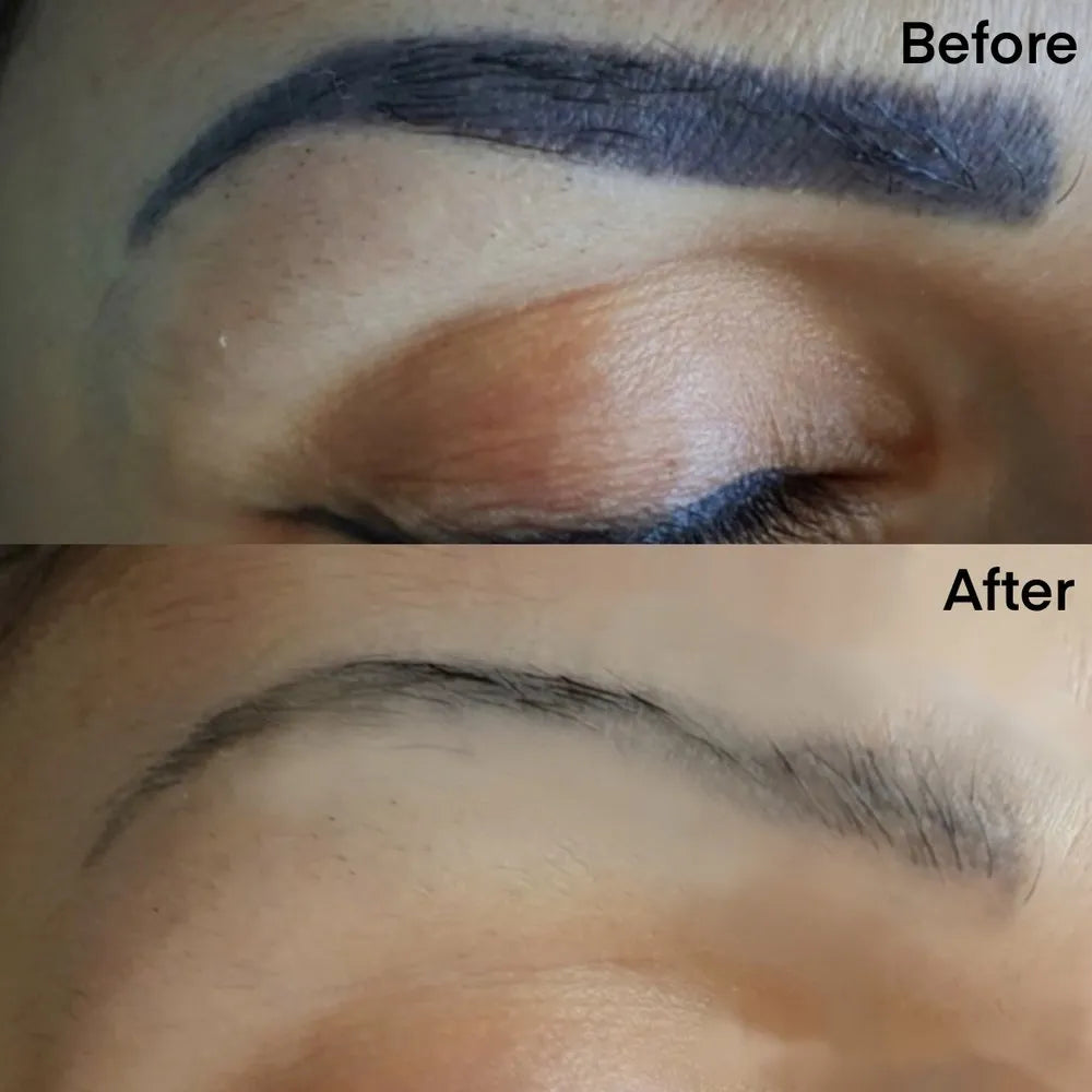 Tatoo Removal Course